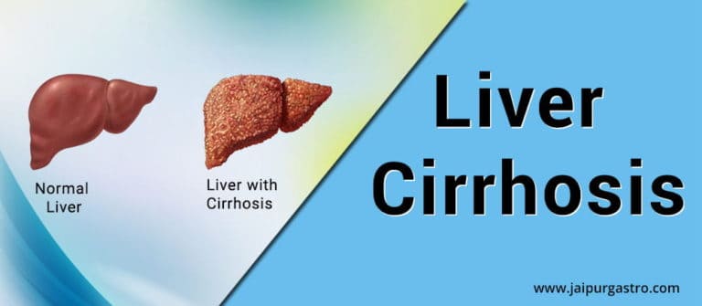 liver-cirrhosis-treatment-liver-specialist-doctor-dr-shankar-dhaka