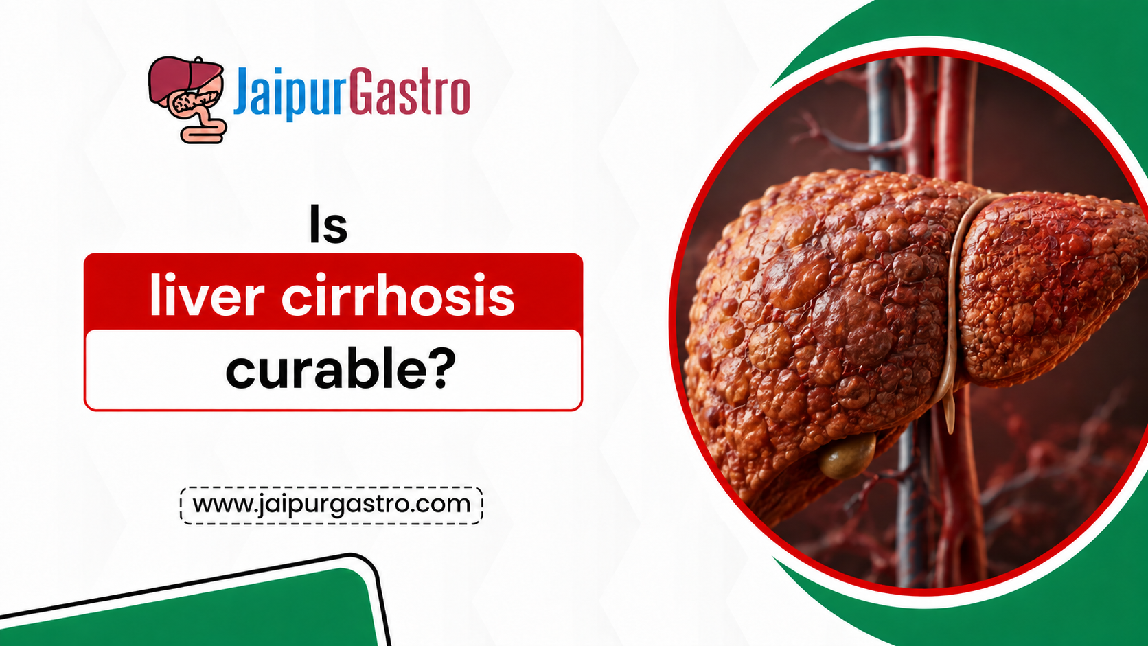 Is liver cirrhosis curable