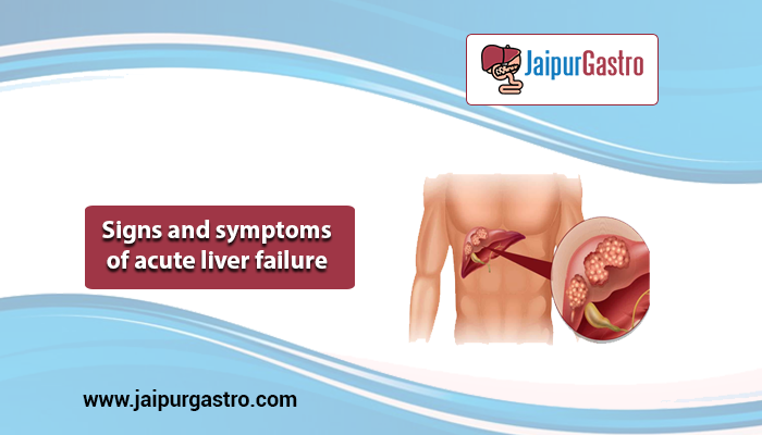 Sign and symptoms of acute liver failure