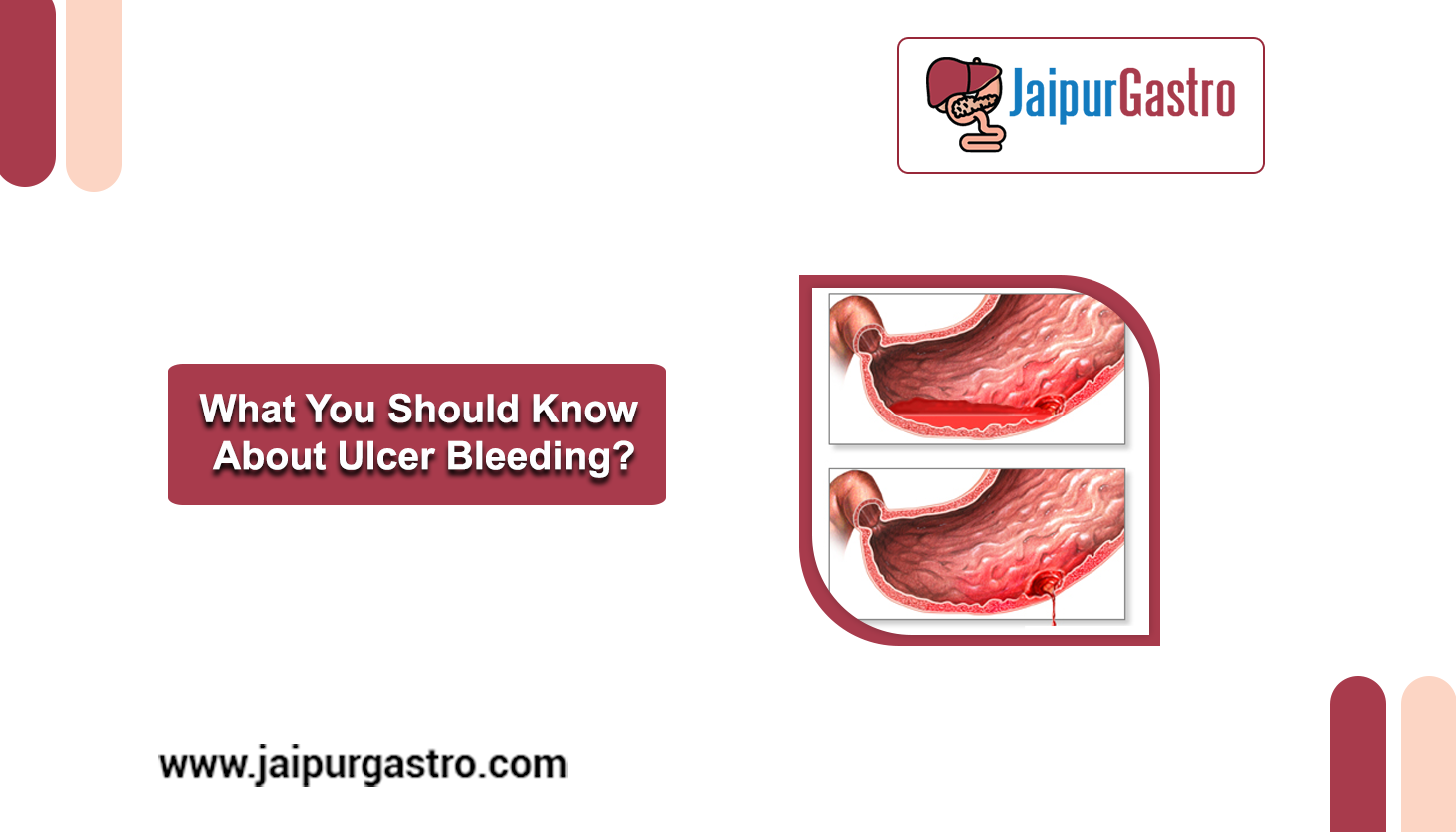 Ulcer Bleeding treatment in 2022