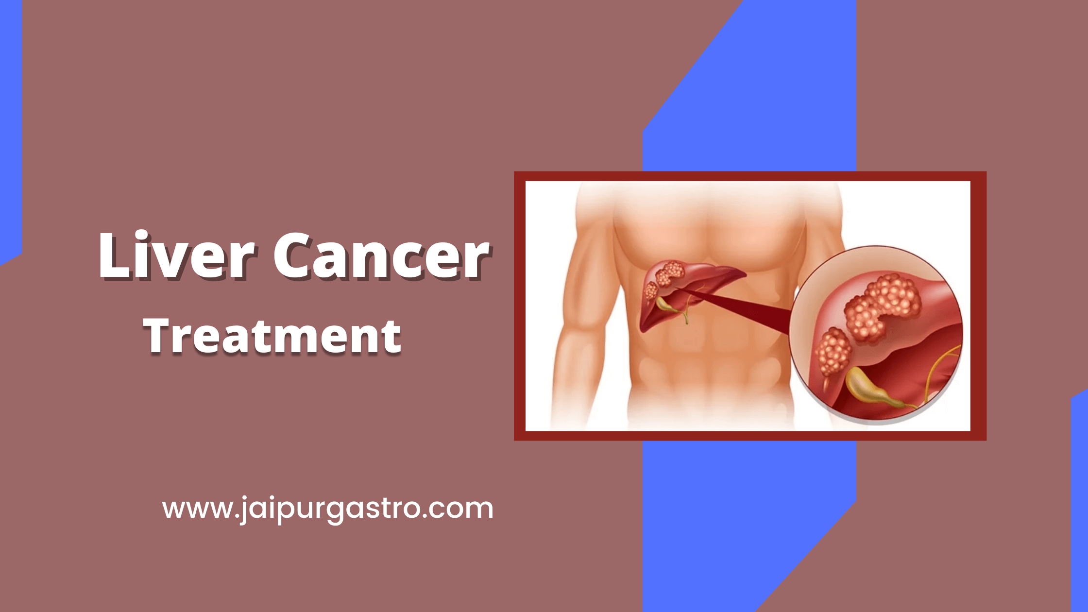 Liver Cancer Treatment In Jaipur