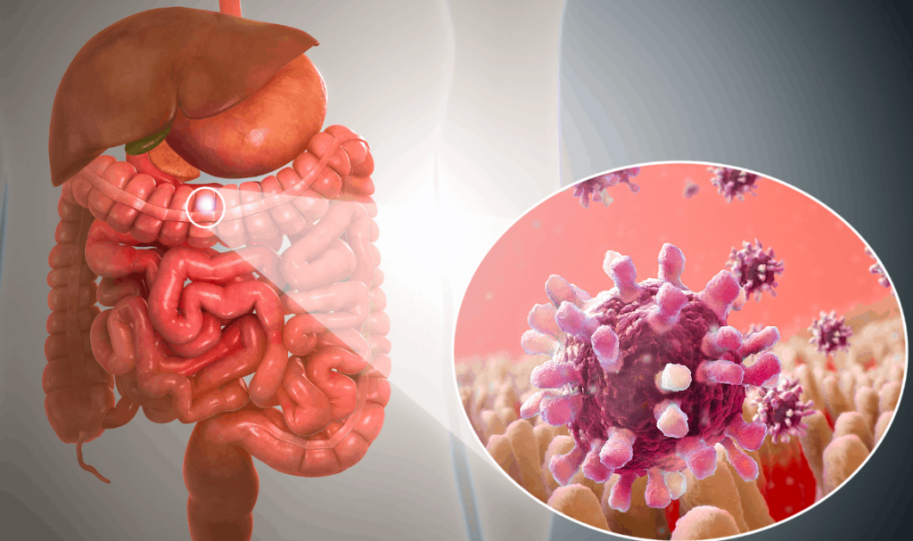 What is gastroenteritis