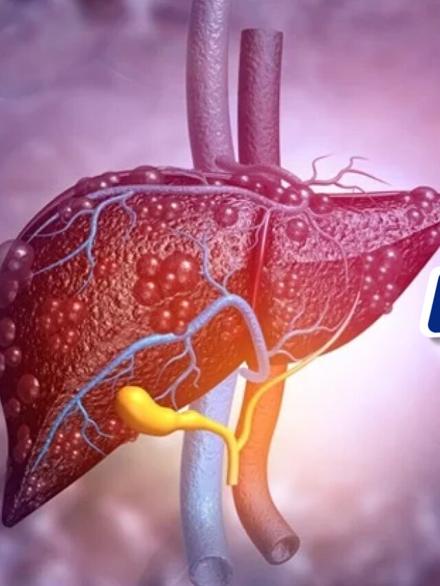 Fatty Liver : फैटी लिवर क्या है?