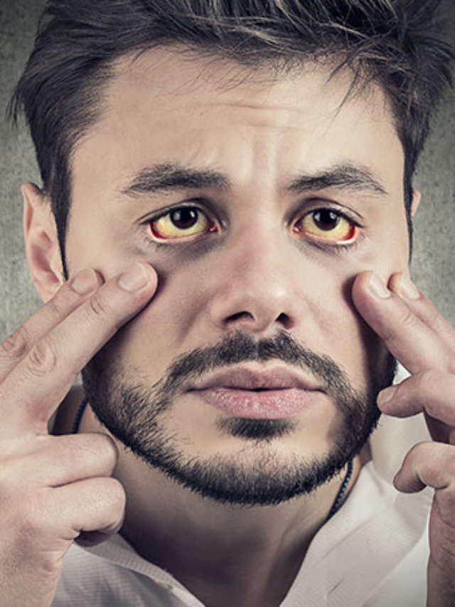 Jaundice: क्या होता है पीलिया?