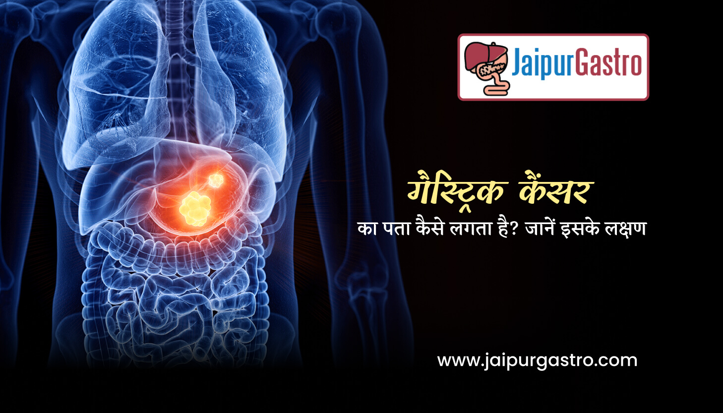 Gastric Cancer in Hindi