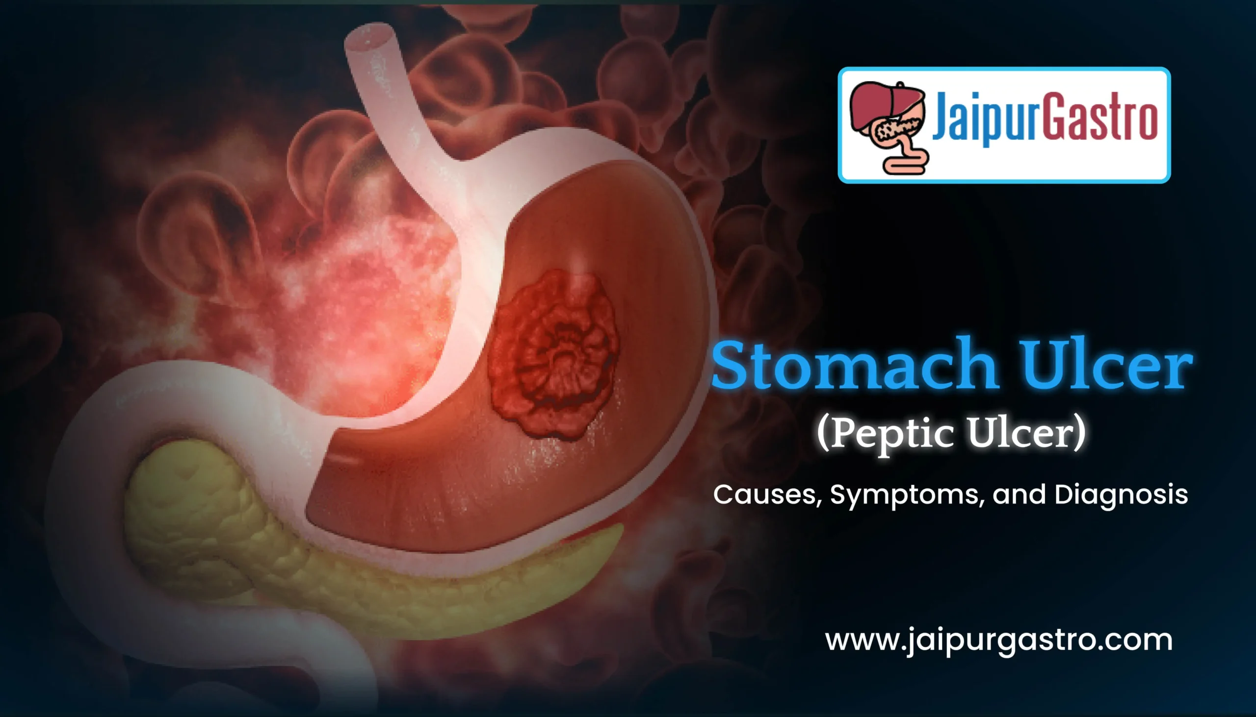 Jaipur gastro:Stomach Ulcer (Peptic ulcer): Causes, Symptoms, and Diagnosis!