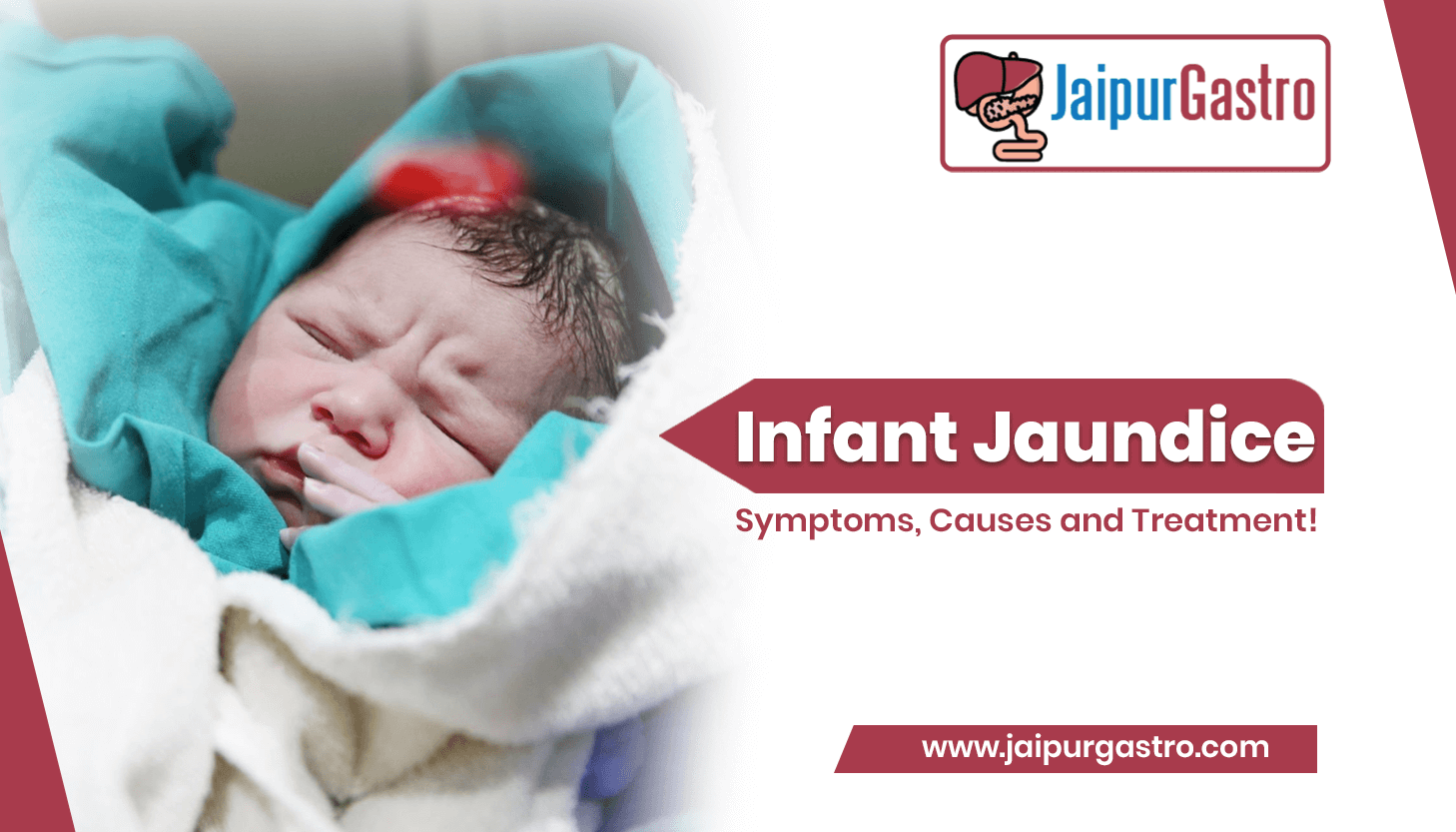 infant jaundice